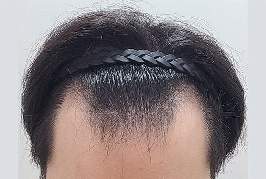 4500모 이식 전
