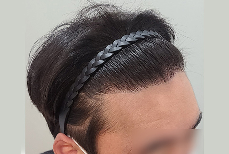 4300모 이식 1년 후