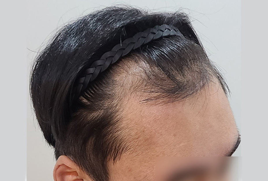 4300모 이식 전