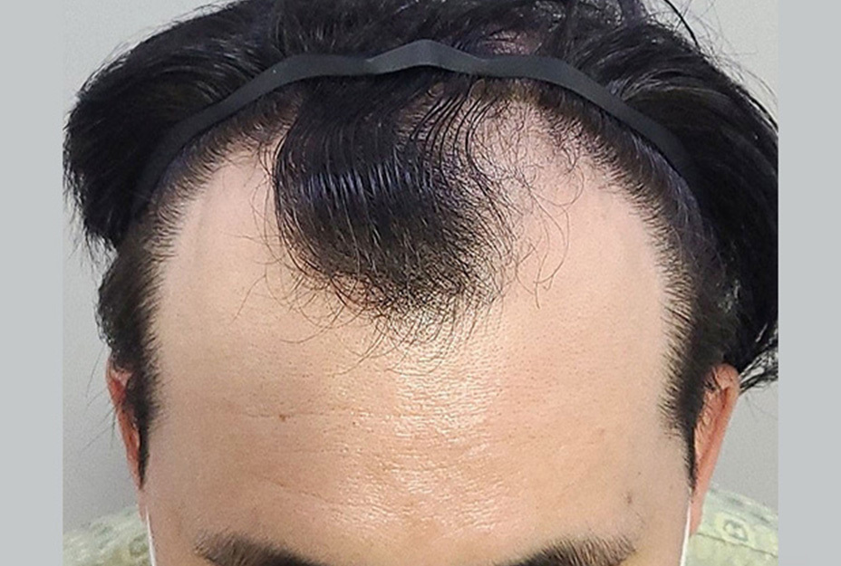 4000모 이식 전