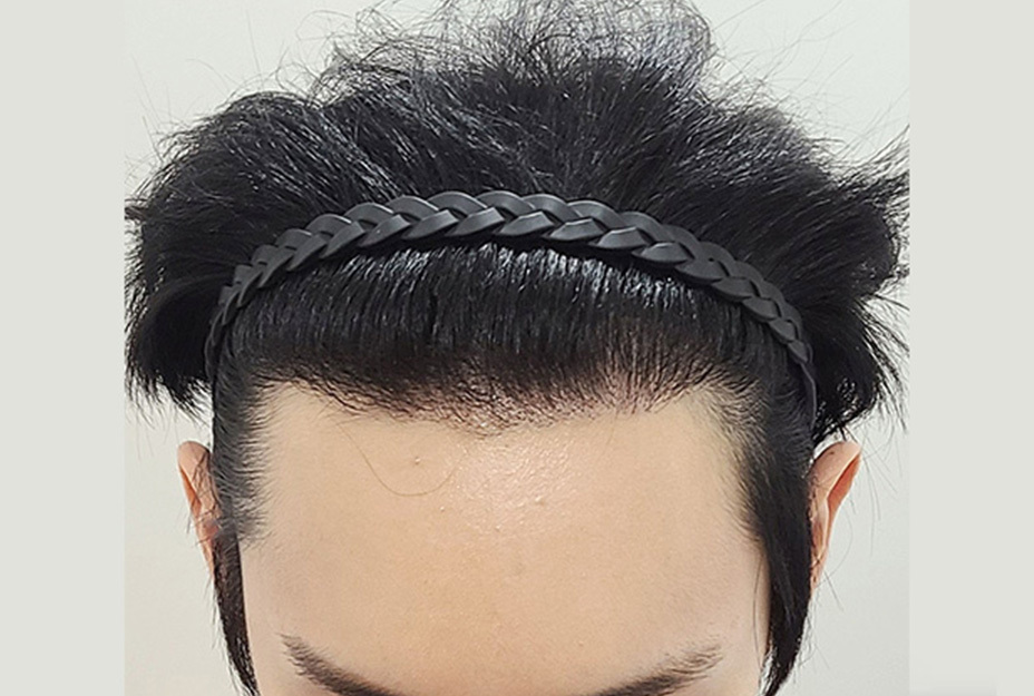 2600모 이식 1년 후