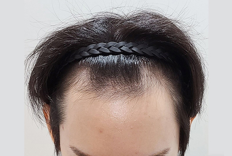 2600모 이식 전