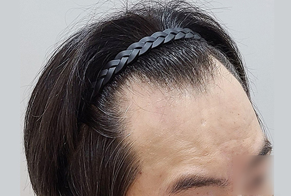 2700모 이식 전