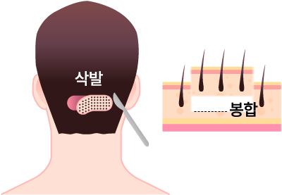 절개법(FUT) 모발이식 일러스트 - 두피 조직을 절개하여 채취 후 봉합