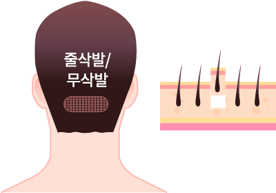 비절개법(FUE) 모발이식 일러스트 - 전용 펀치로 모낭을 하나씩 채취