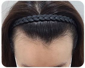 M자형 이마 헤어라인 교정 유형