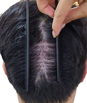 채취 후 2일차 두피 상태 — 빗으로 가른 후두부 채취 부위