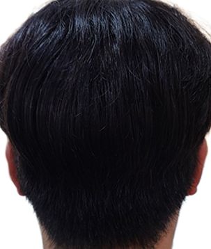 채취 후 2일차 후두부 자연스러운 모발 커버 상태